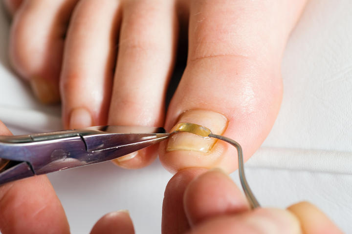Cómo prevenir y tratar las uñas enterradas