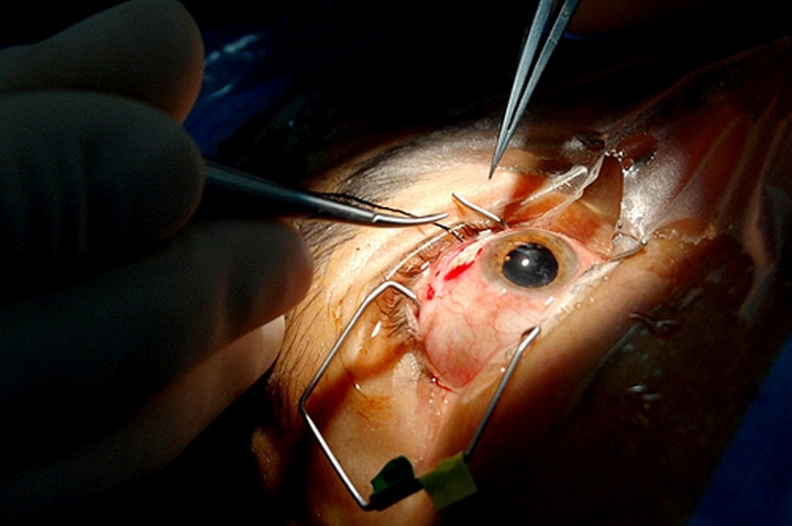 Cirugías de los ojos les cambian la vida