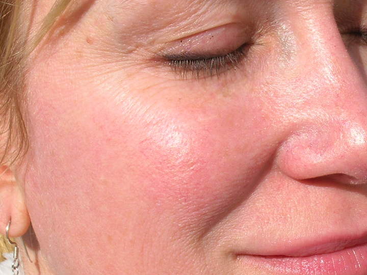 'Una enfermedad poco conocida, la rosácea'