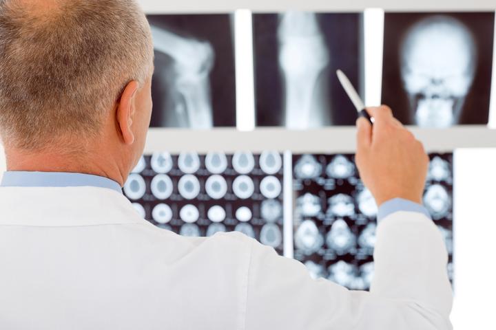 Osteoporosis, enfermedad que no avisa