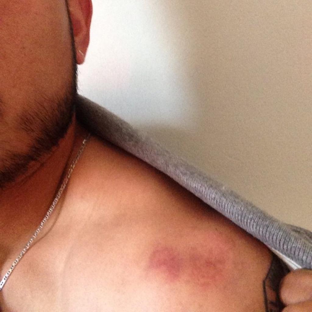 Jesús Zavala enseña la mordida que le dio Arango