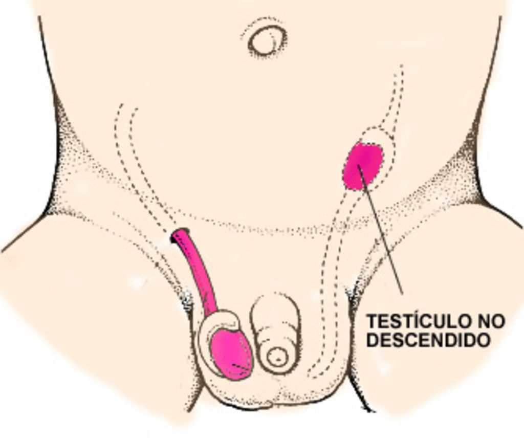 Criptorquidia, enfermedad causante de infertilidad