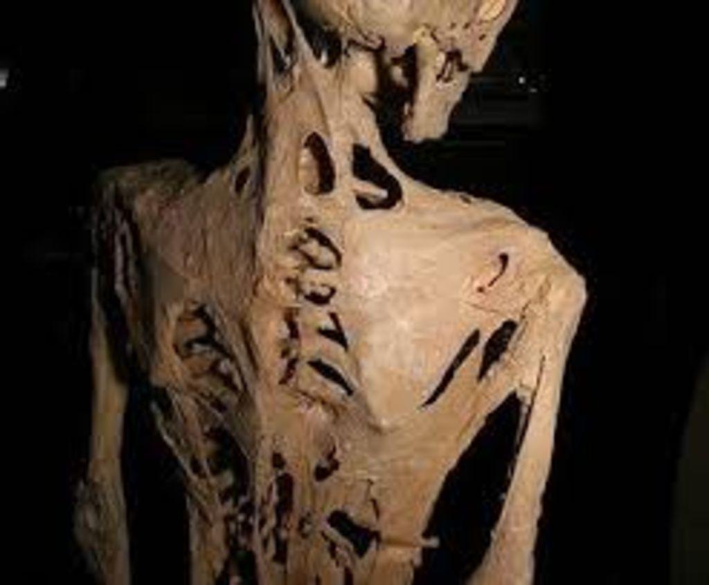 Cerca del tratamiento del síndrome del hombre de piedra