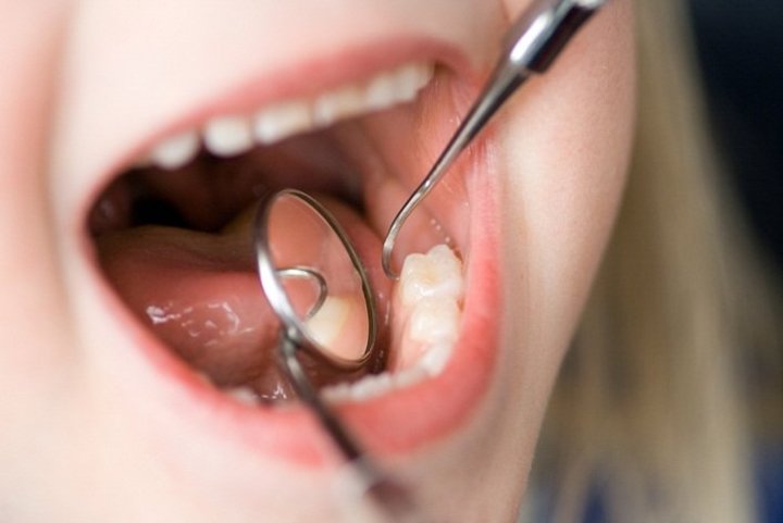 Besar a niños es causa de caries