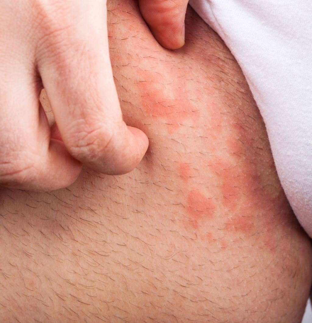 Urticaria crónica puede tardar años en tratarse bien