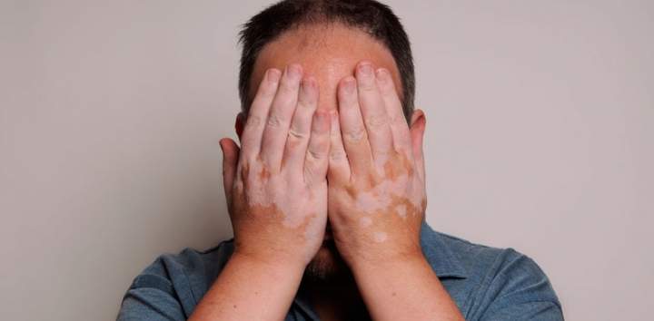 Vitiligo