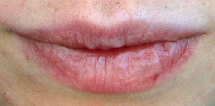 Labios secos