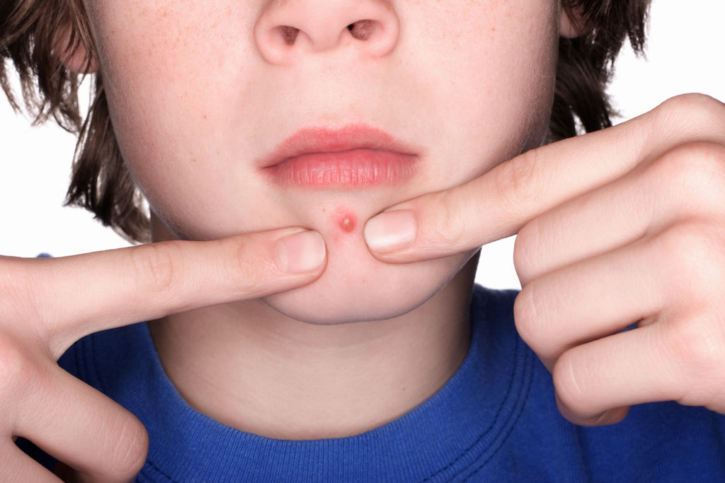 Evita pellizcar granos o espinillas por acné