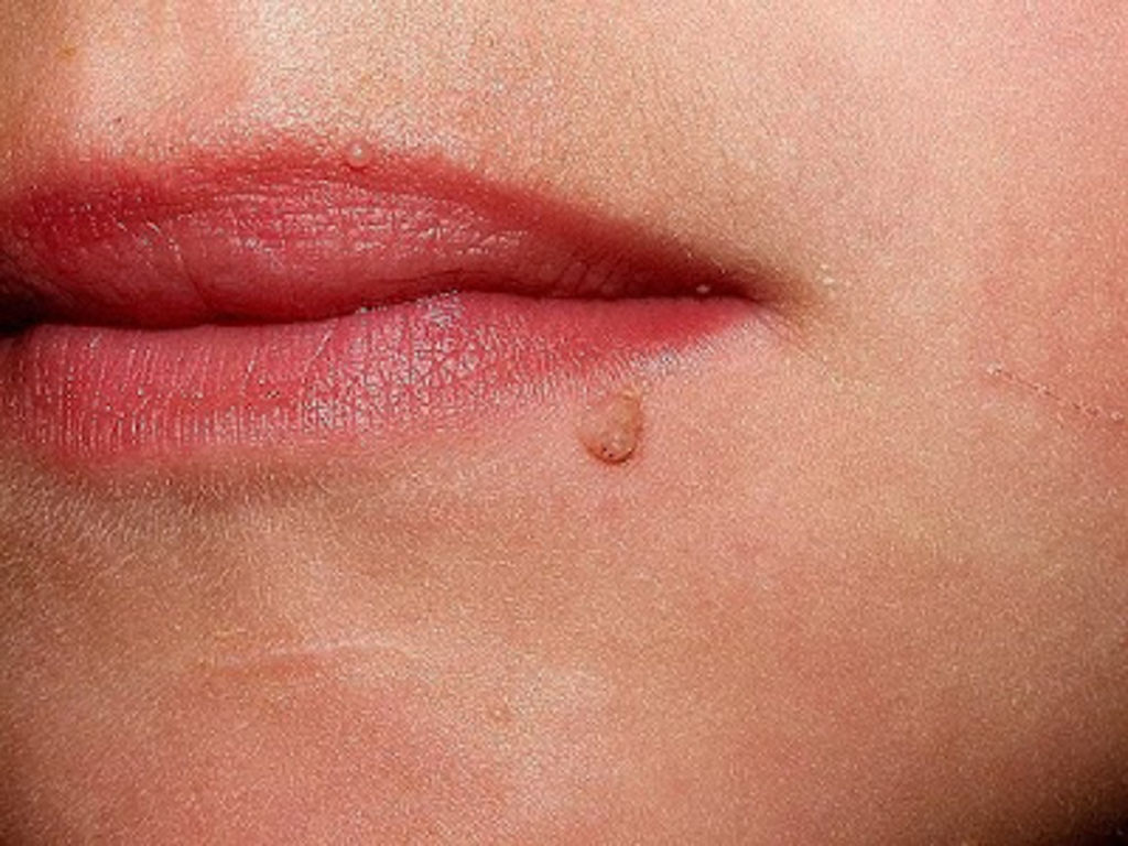 Importante la atención de verrugas