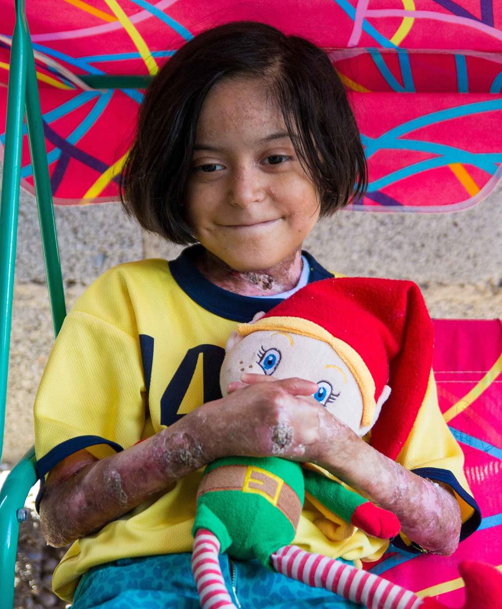 Festejan cumpleaños a niña con 'piel de mariposa'