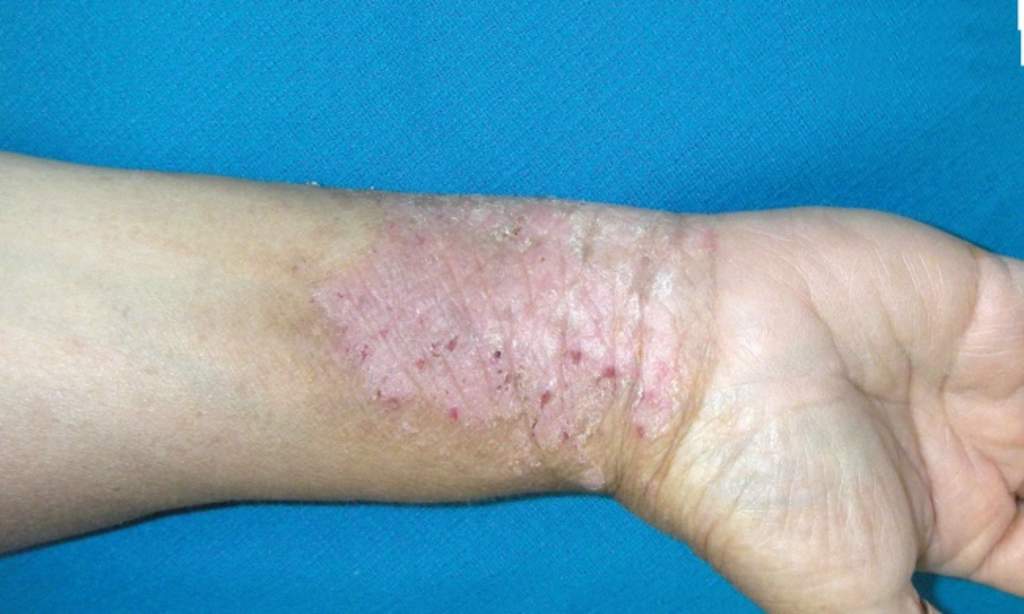 Padecen psoriasis al menos 2.5 millones de mexicanos