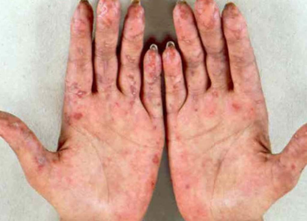 ¿Qué es el lupus?