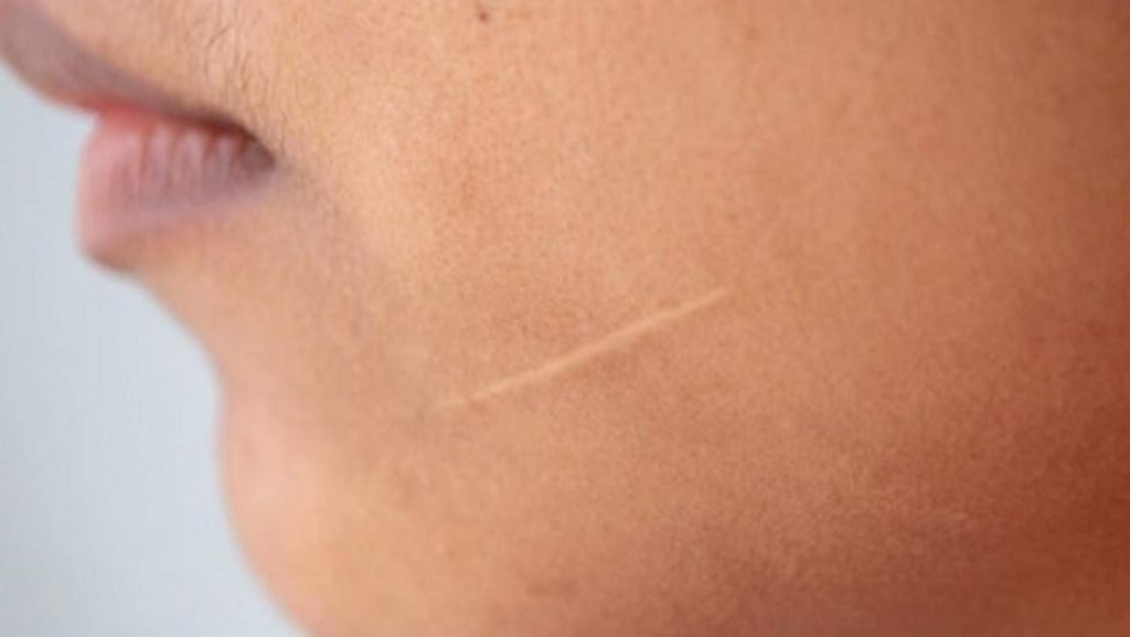 Apuntan estudios científicos a sanar heridas sin dejar cicatriz