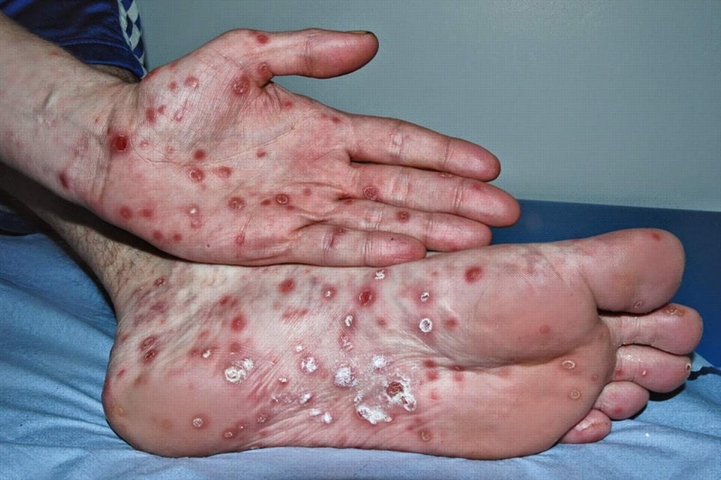 La sífilis es la enfermedad más común en hombres homosexuales del sur de EU