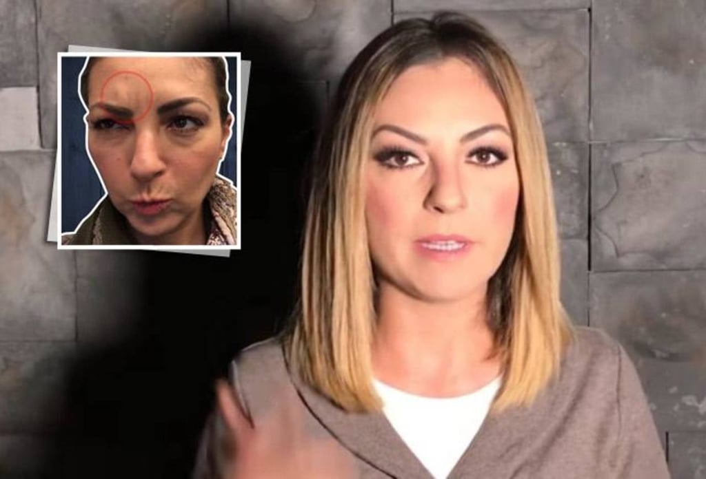 Mariana Ochoa deformó su rostro con bótox