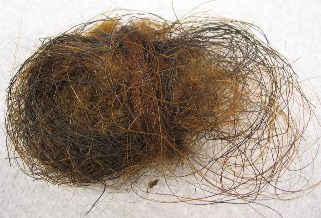 Extraen bola de cabello del estómago de una mujer