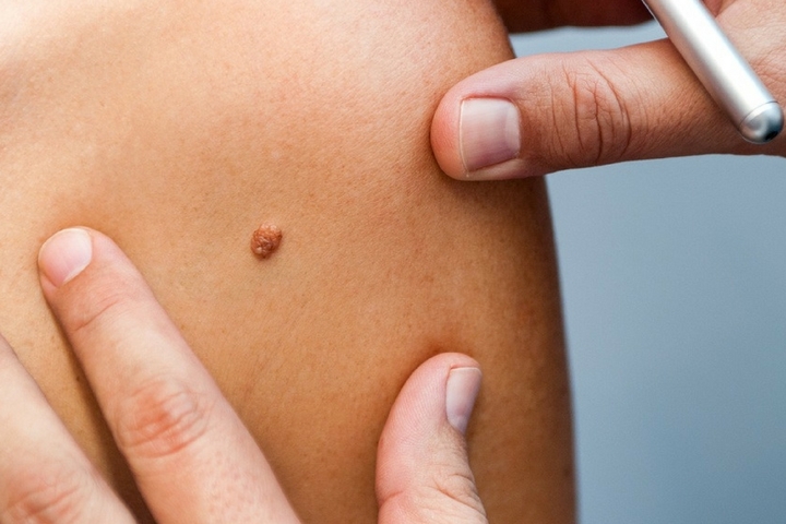 ¿Cómo se tratan las verrugas?