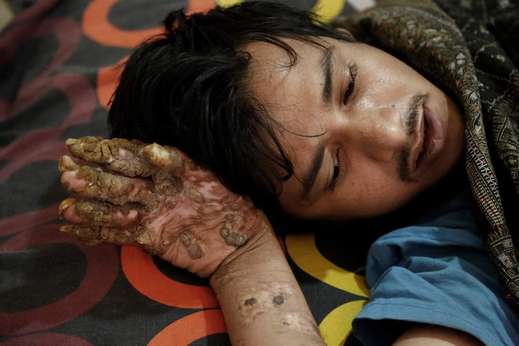 El 'hombre árbol', dos años atrapado en un hospital de Bangladesh