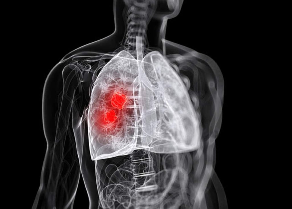 Fundamental, detección temprana del cáncer de pulmón