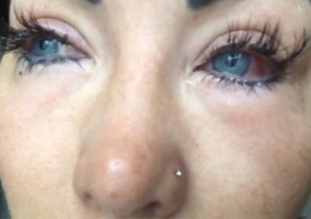 Intagramer con ceguera tras cirugía de cambio de color de ojos