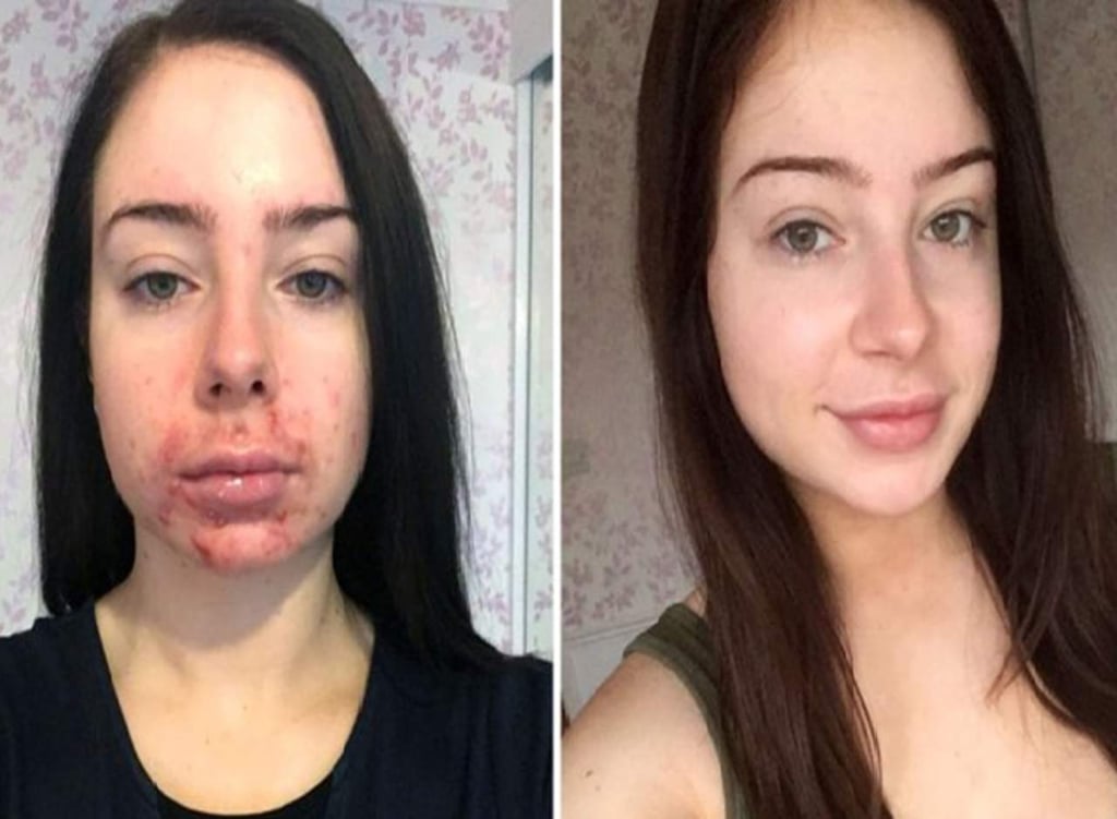 Cortar con su novio la inspiró a compartir su batalla con el acné