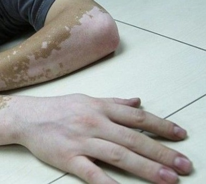 Tres casos de 'mal del pinto'