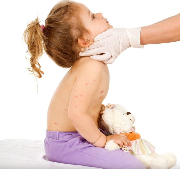 Mitos y certezas sobre la varicela