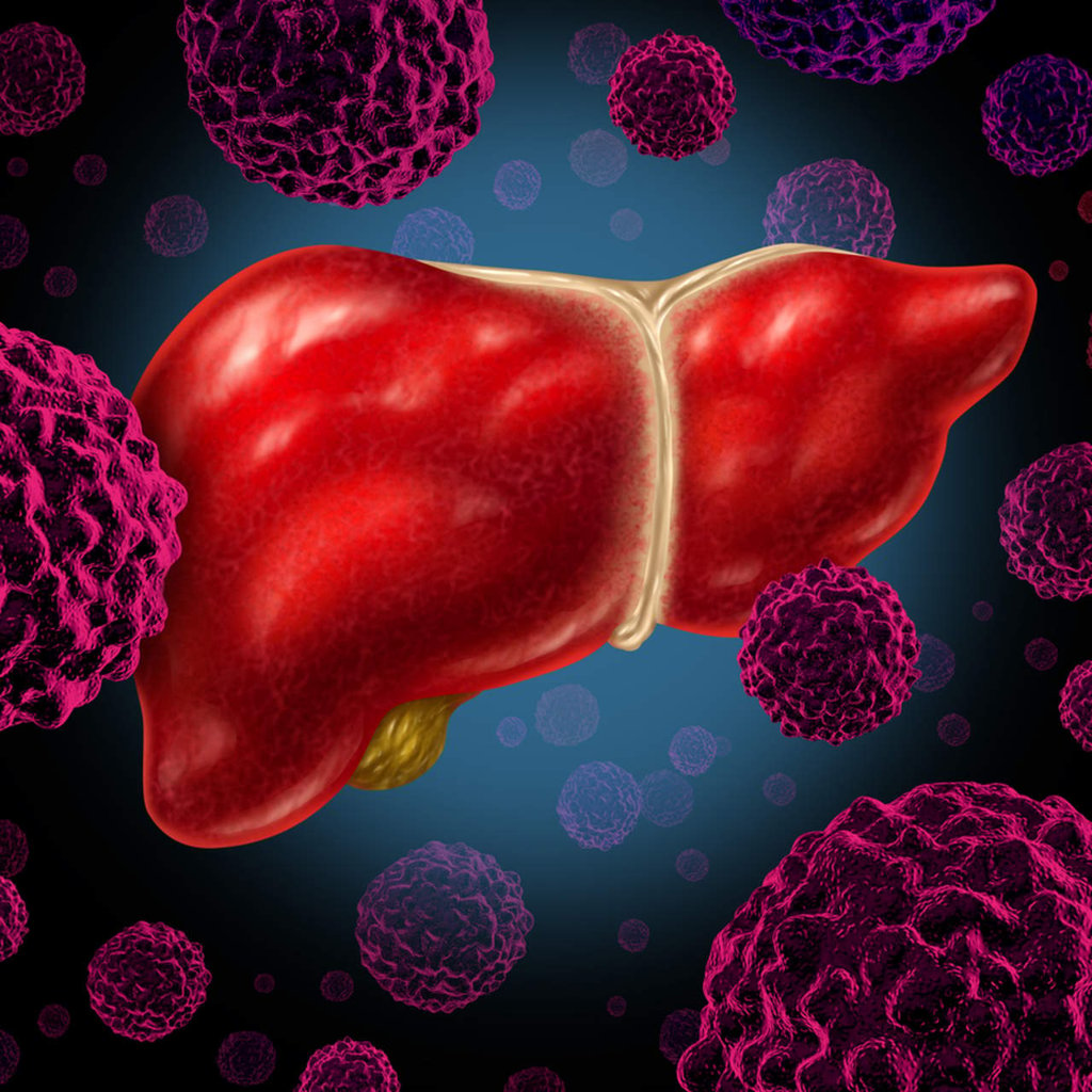 Hígado graso, enfermedad 'silenciosa' que puede derivar en cirrosis o cáncer