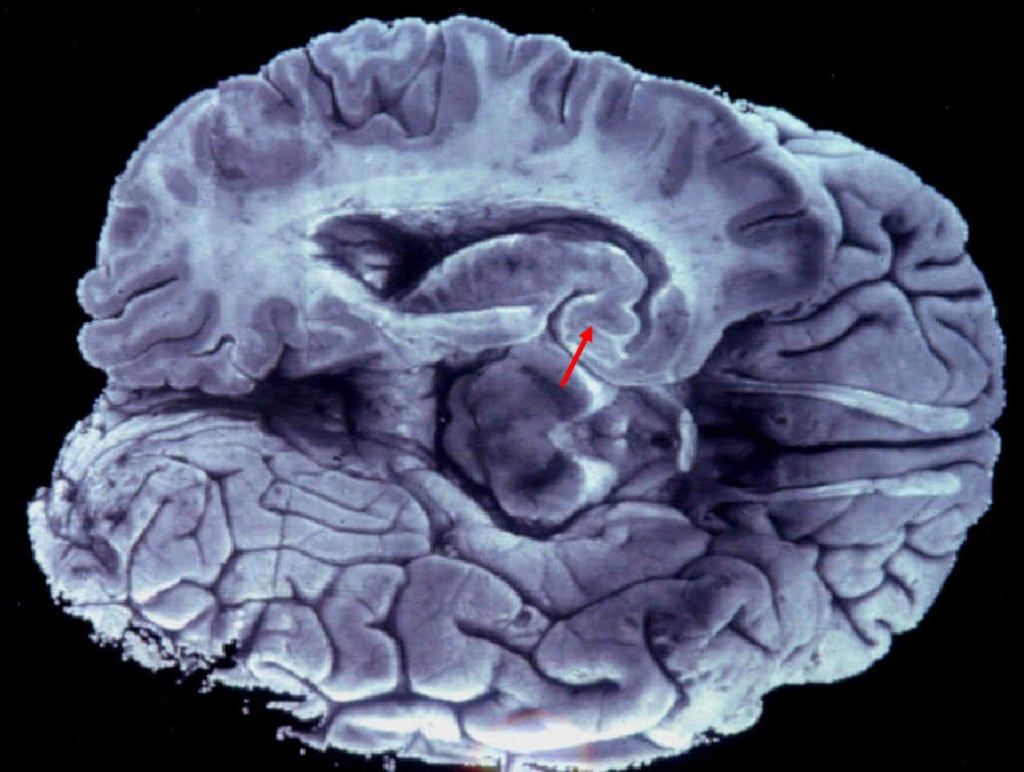 Mantener activo el cerebro ayuda a prevenir enfermedades neurológicas
