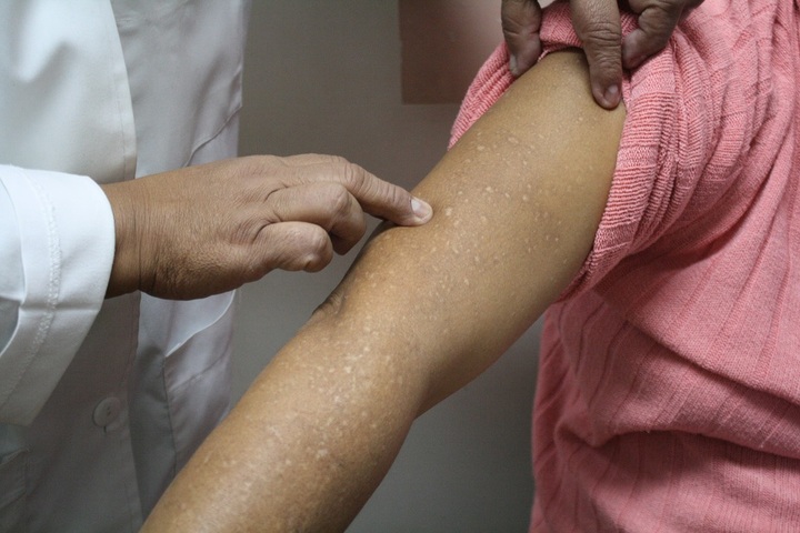 Registran 266 casos de escabiosis