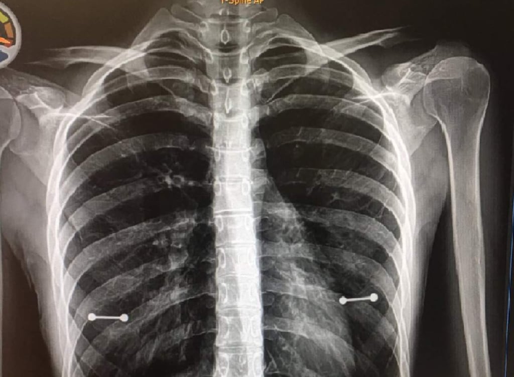 Se entera del secreto de su hija por unos rayos X