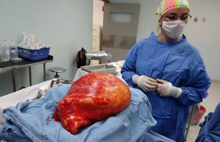 Extirpan a mujer tumor abdominal de 17 kilos