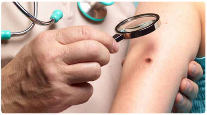 'Durango, con bastantes casos de cáncer en piel'