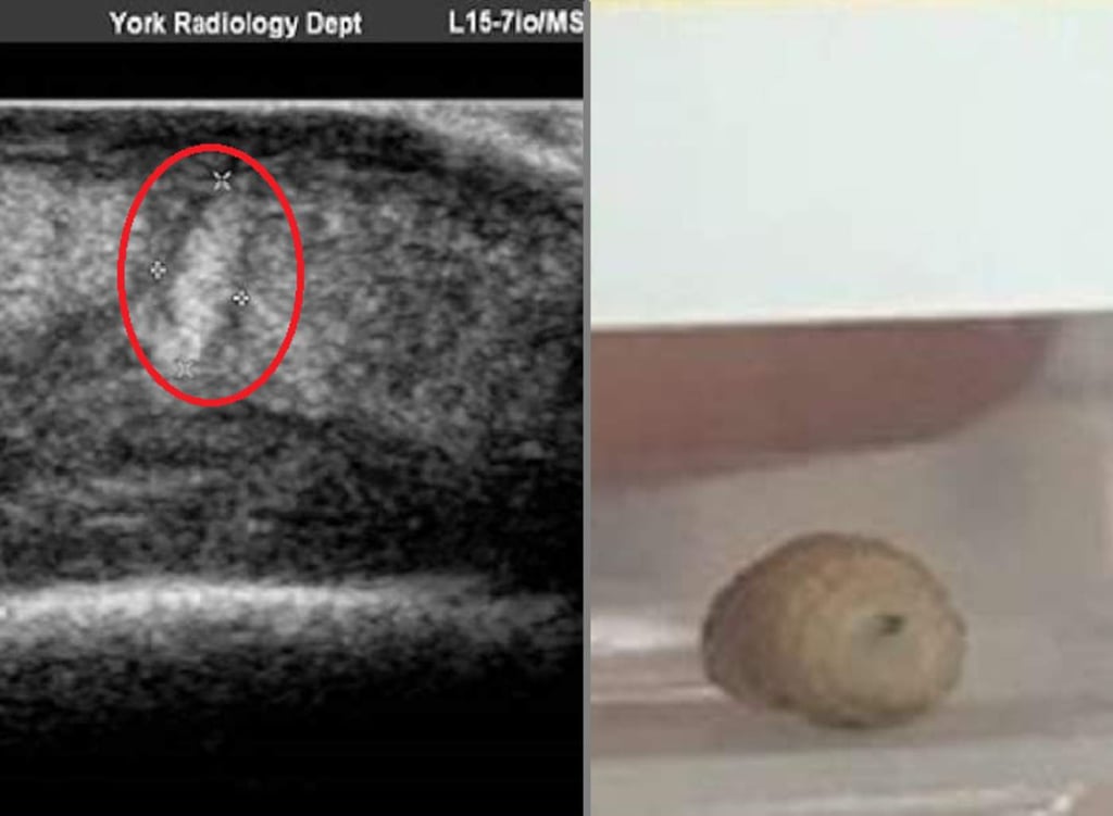 Mujer con la frente hinchada tenía dos gusanos en la cara