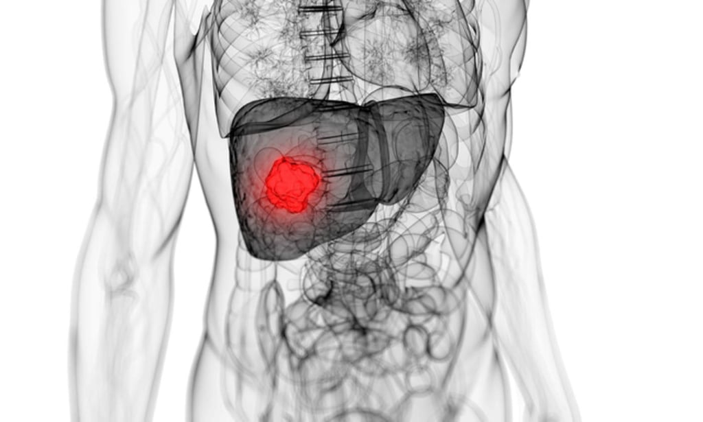 Factores de riesgo del cáncer de hígado