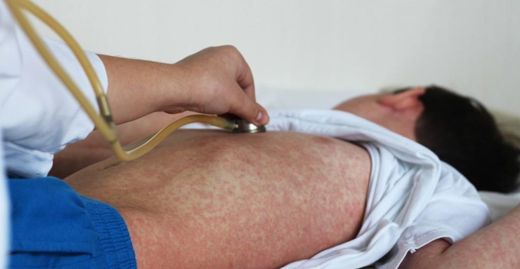 Aumentan casos de sarampión en EUA por brote en Nueva York