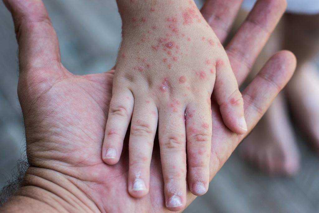 Casos de sarampión en EUA siguen en aumento; superan los 800