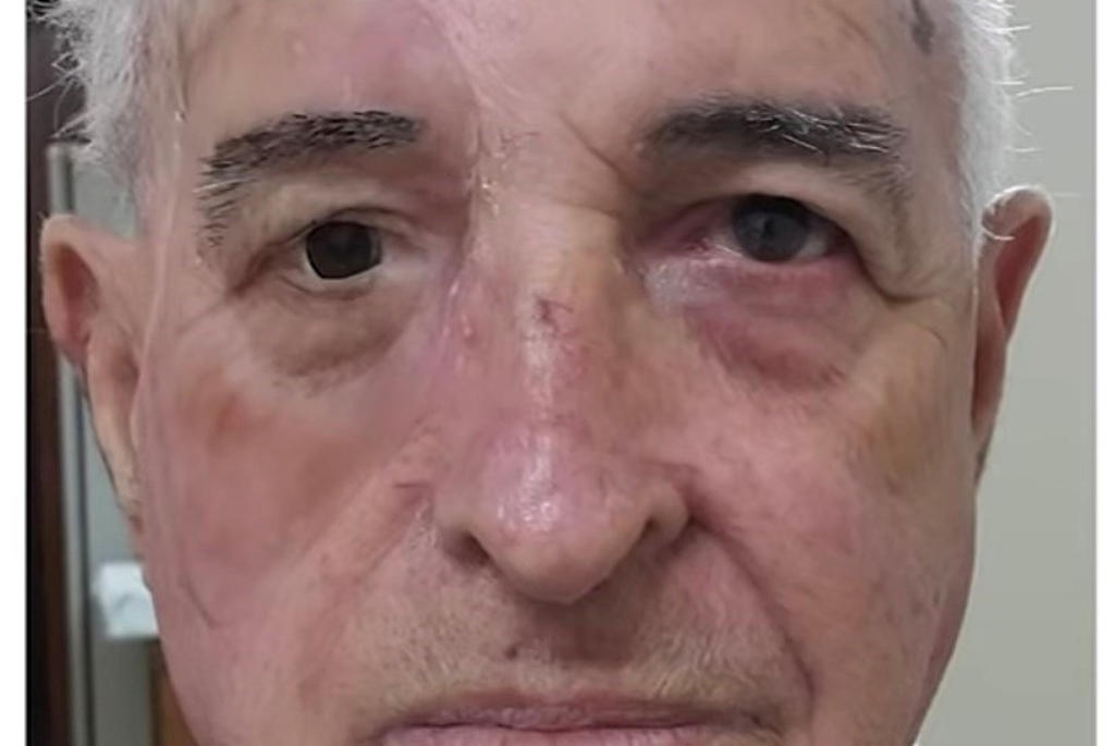 Una prótesis facial a partir de modelos 3D para pacientes de cáncer