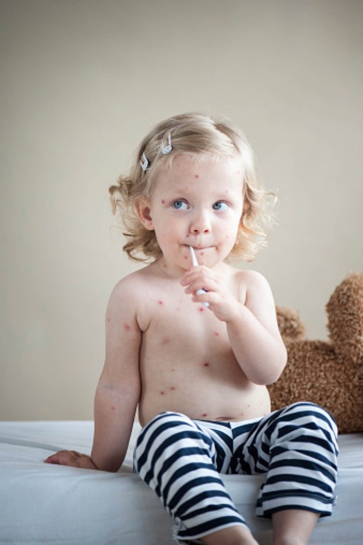 Sarampión en niños