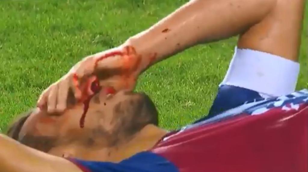 Jugador del Atlante sufre una sangrienta lesión