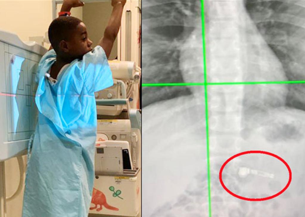 Niño se traga accidentalmente unos Air Pods