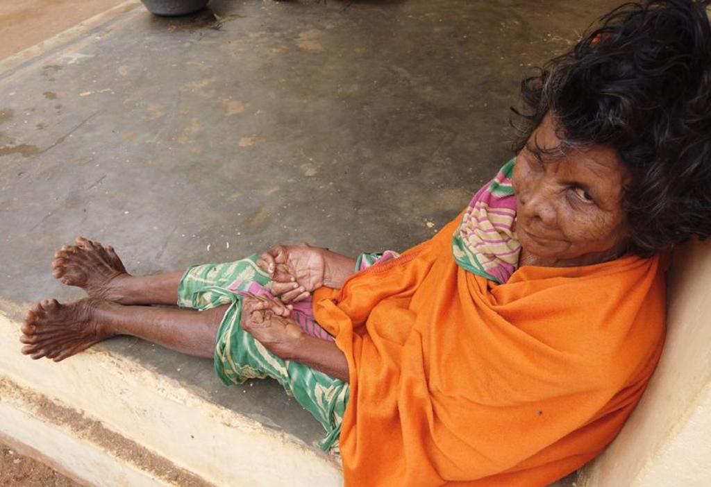 Mujer tiene 31 dedos, 19 en pies y 12 de manos