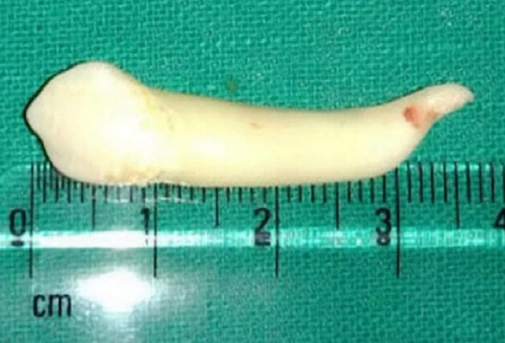 Dentista extrae de su paciente un diente de 3.8 centímetros