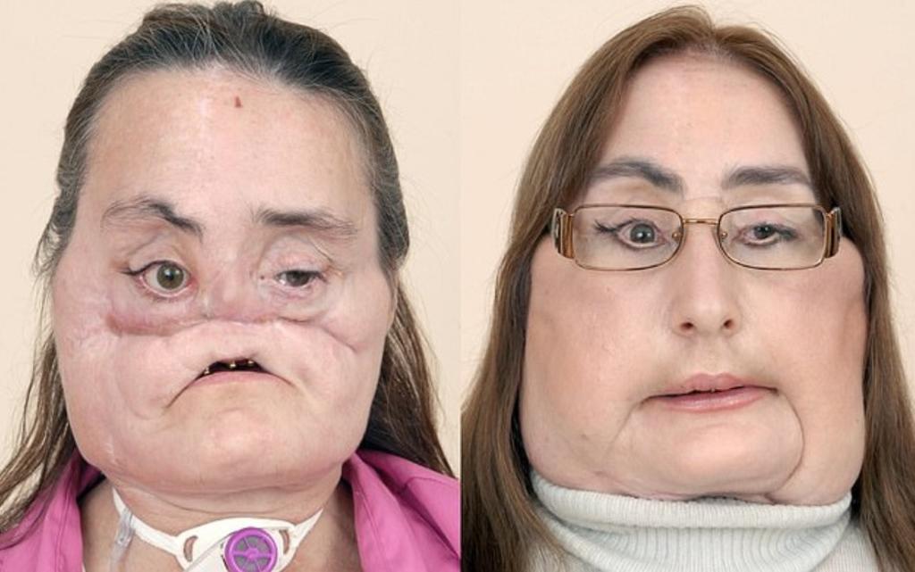 Connie Culp, la mujer que recibió el primer trasplante facial muere a los 57