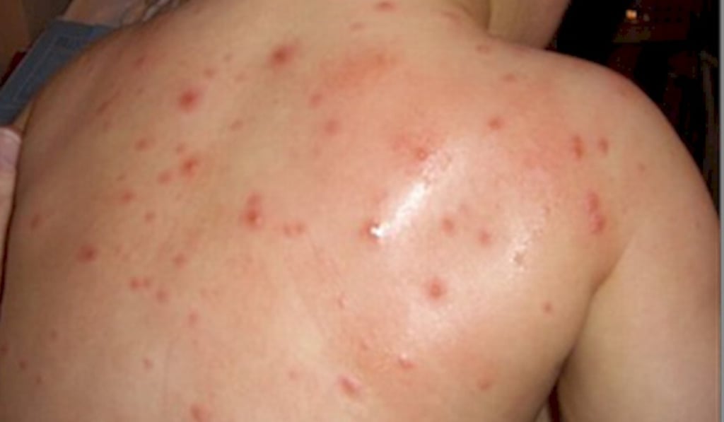 Atendidos un total de 352 casos de varicela
