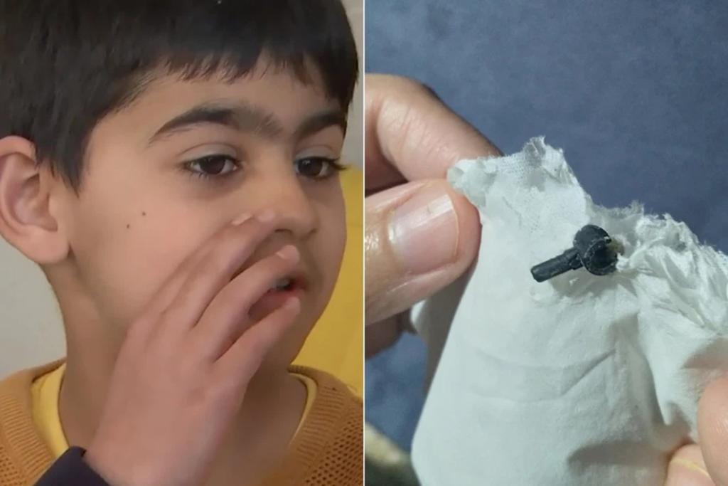 Pieza de Lego estuvo dos años atorada en la nariz de un niño