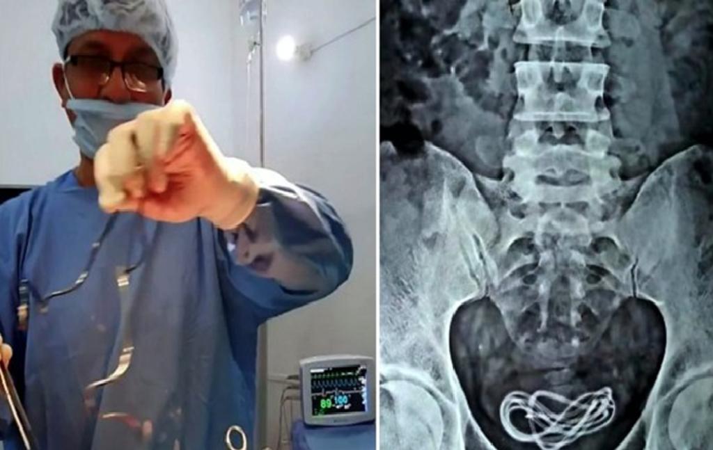 Doctores extraen cargador de celular de la vejiga de un paciente