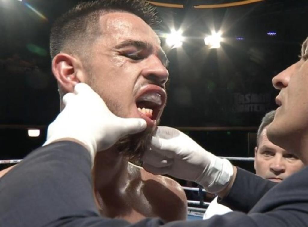 Boxeador impresiona al compartir video de su fractura de mandíbula