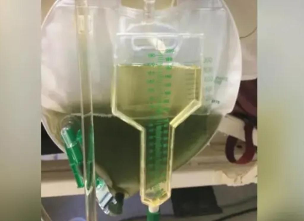 Hombre cuya orina se volvió verde llegó al hospital por dificultad para respirar
