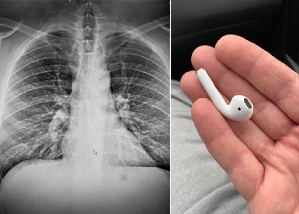 Se traga unos audífonos y se entera hasta después en una radiografía